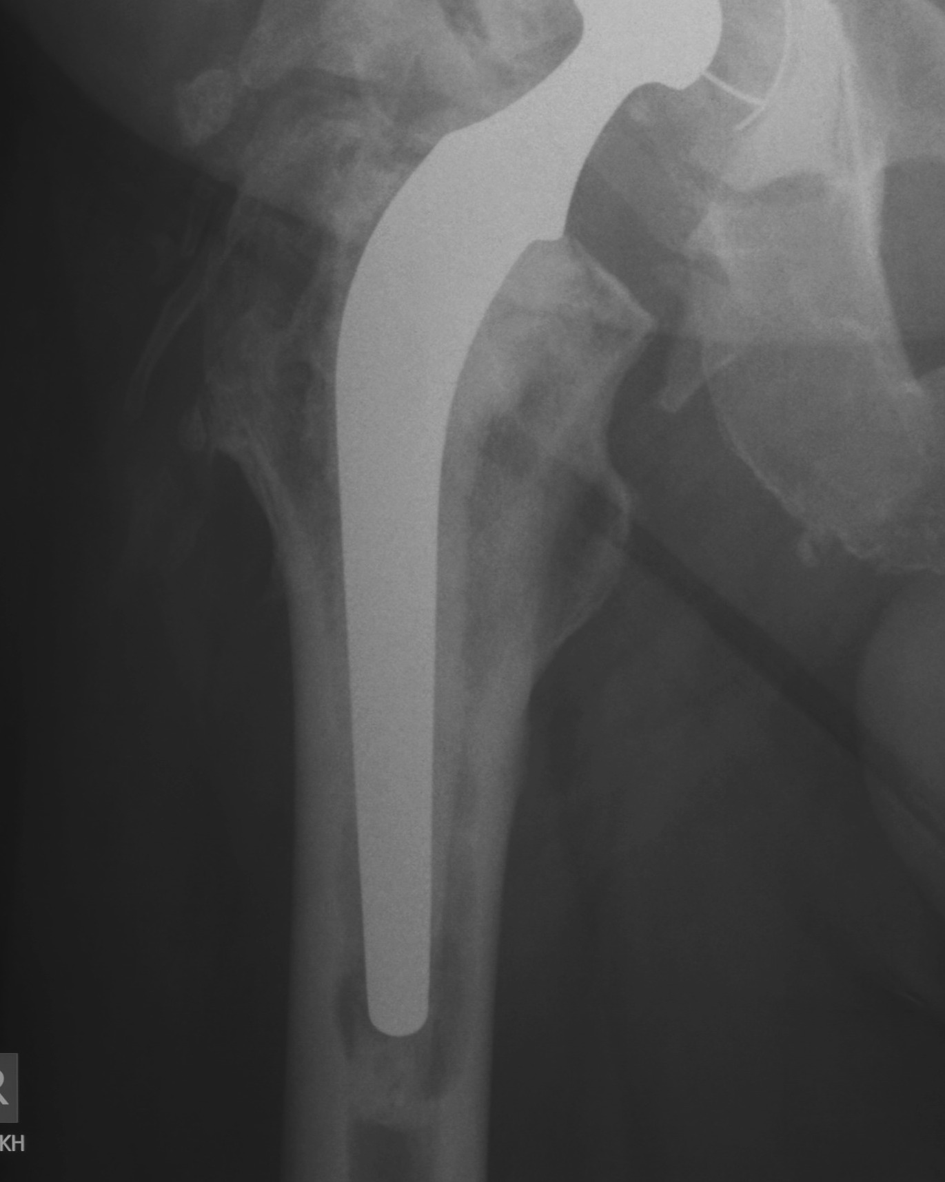 Revision Femur Type 1 Standard Cemented Stem Pre op